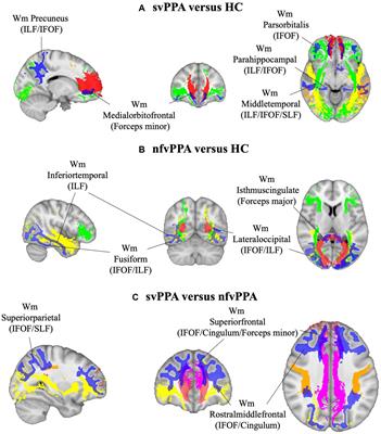 Asymmetry of radiomics features in the white matter of patients with primary progressive aphasia